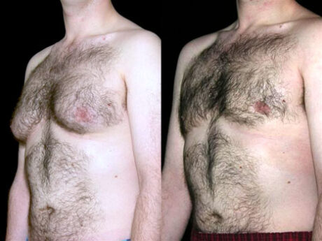 Gynecomastia (Male Breast Reduction) case #37781