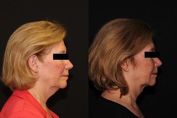 Kybella case #37637