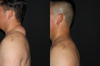 Minimal Scar Lipoma Removal case #37924