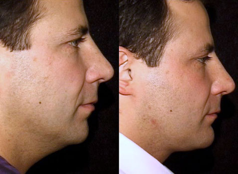 neck_lipectomy_chin_implant3_before_and_after