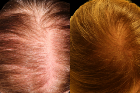 Hair Restoration case #37974