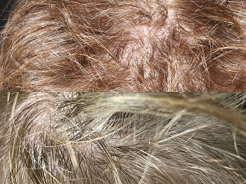 Hair Restoration case #37963