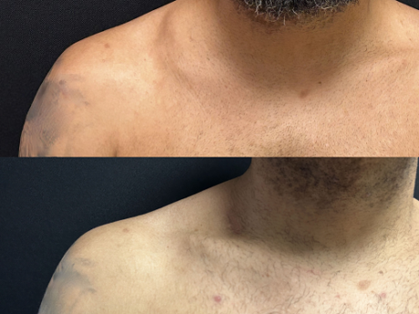 Minimal Scar Lipoma Removal case #37927