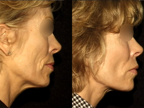 Facelift case #38704