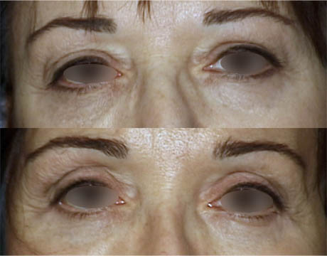 Blepharoplasty case #39283