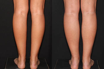 1_0001_Z-calf-augmentation-20111205113826235-20200819092830228.png