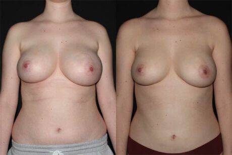 Breast Liposuction case #39730