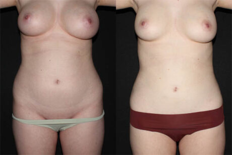 Breast Liposuction case #39730