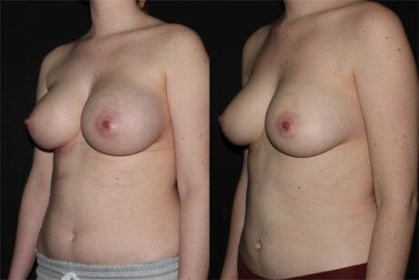 Breast Liposuction case #39730