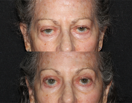 Blepharoplasty case #39631