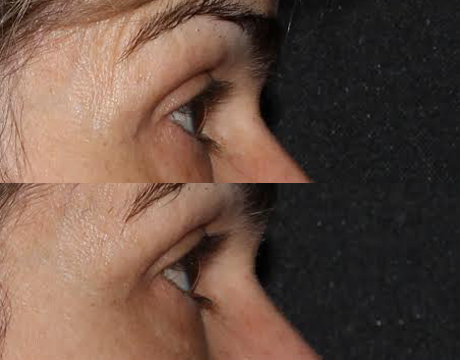 Blepharoplasty case #40692