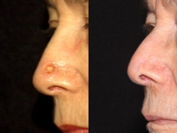 Nasalreconstruction-19980624124307171-20170921133011271-e1506016927178