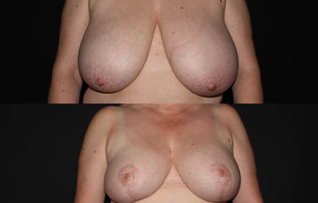 Breast Reduction case #40860