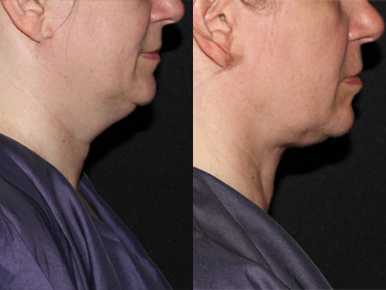 Neck & Jowl Liposuction case #40853