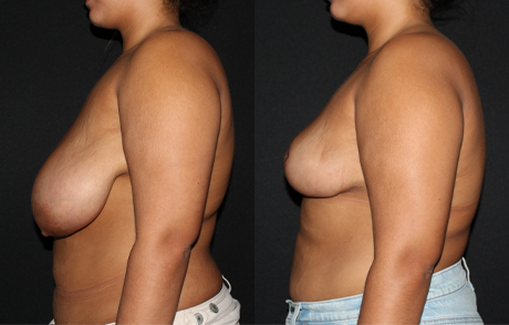 Breast Reduction case #41188
