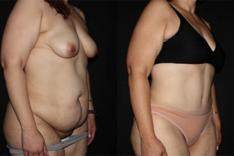 Tummy Tuck case #41143