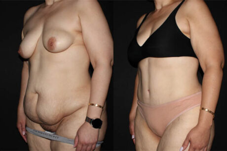 Tummy Tuck case #41143