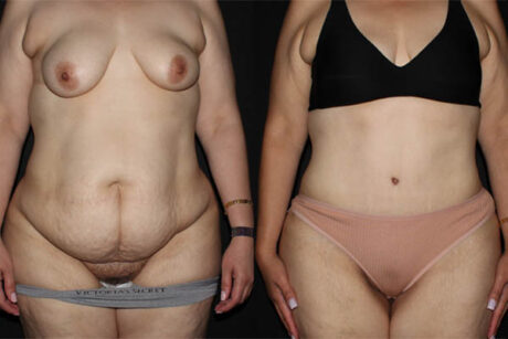 Tummy Tuck case #41143