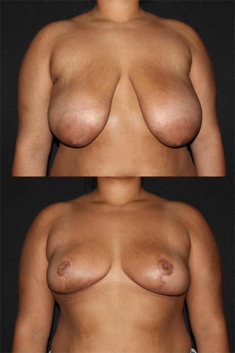 Breast Reduction case #41188