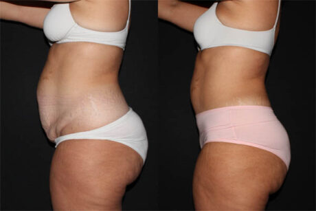 Skin Tightening After Weight Loss case #41476