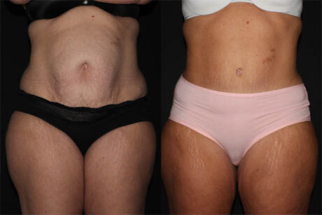 Tummy Tuck case #41476