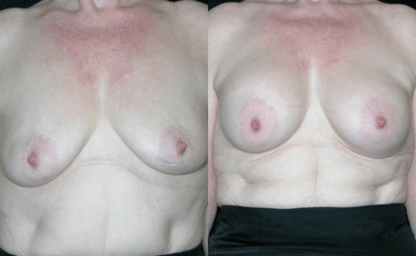 Breast Augmentation case #41727