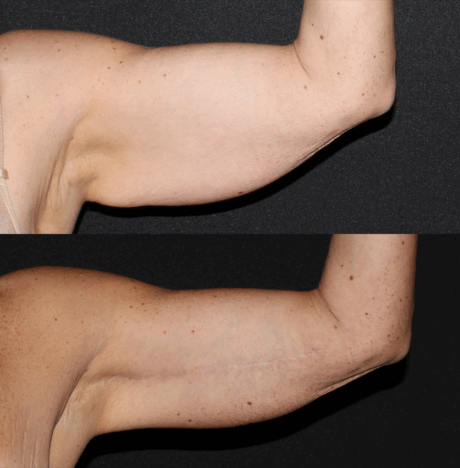 Arm Lift case #41753