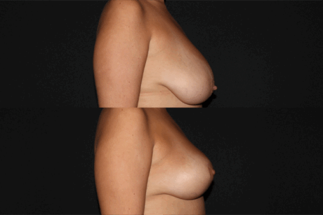 Breast Reduction case #41607