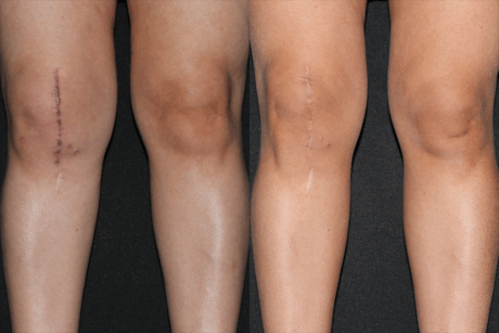 Scar Revision case #41748