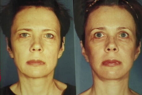 Endoscopic Brow Lift case #42006