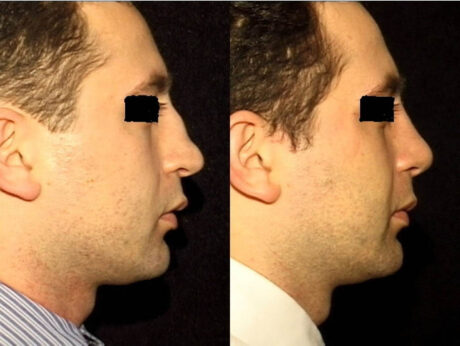 Rhinoplasty case #41858