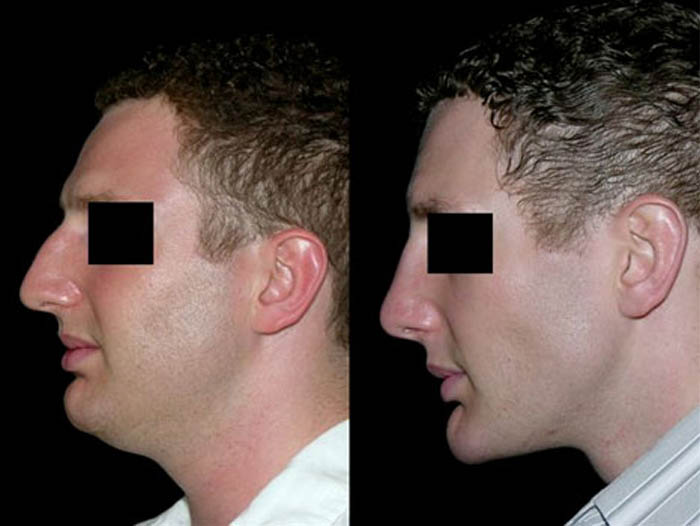 1_0000_rhinoplasty_neck_lipectomy_chin_implant1.jpg