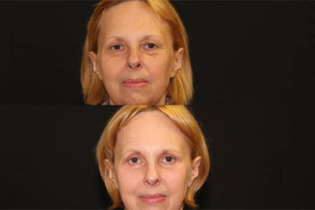Endoscopic Brow Lift case #42011