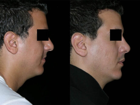 Rhinoplasty case #41863