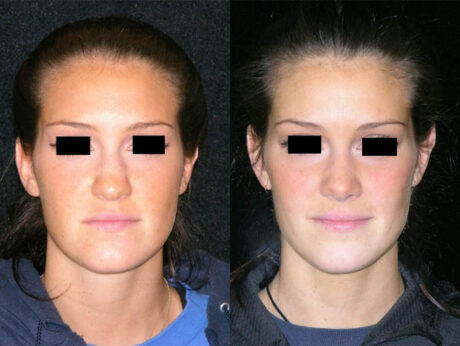 Rhinoplasty case #41868