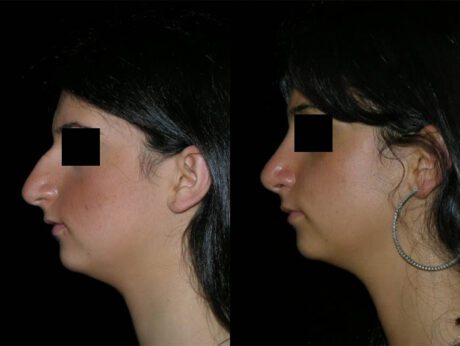 Rhinoplasty case #41873