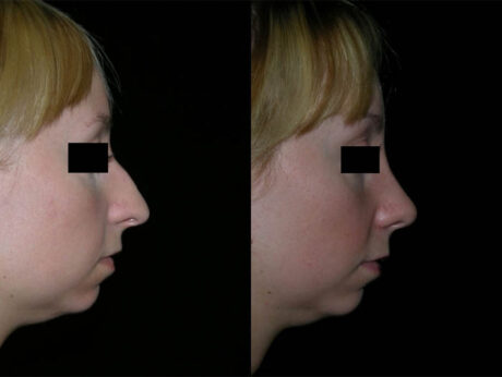 Rhinoplasty case #41878