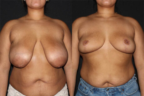 Breast Reduction case #42125