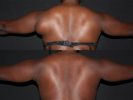 Minimal Scar Lipoma Removal case #42086