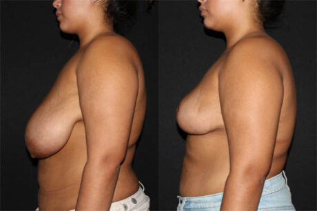 Breast Reduction case #42125