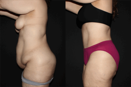 Tummy Tuck case #42168