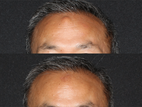 Minimal Scar Lipoma Removal case #42334