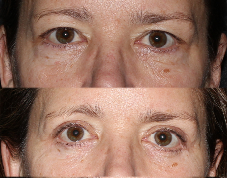 Blepharoplasty case #42281
