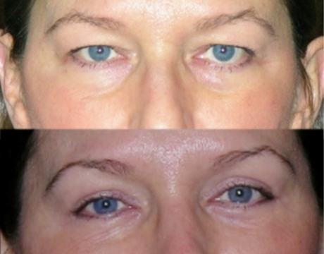 Blepharoplasty case #42295