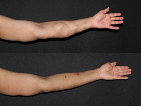 Minimal Scar Lipoma Removal case #42268