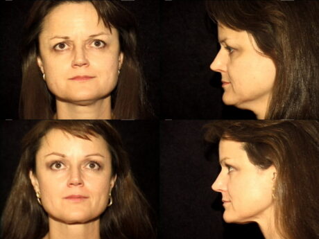 Endoscopic Brow Lift case #42648