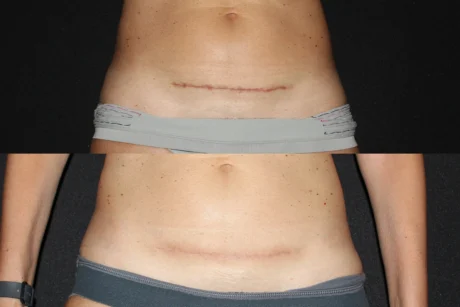 Scar Revision case #42529