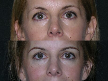 Eyeliner, Lip, and Eyebrow Tattooing case #42860