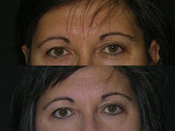 Eyeliner, Lip, and Eyebrow Tattooing case #42850