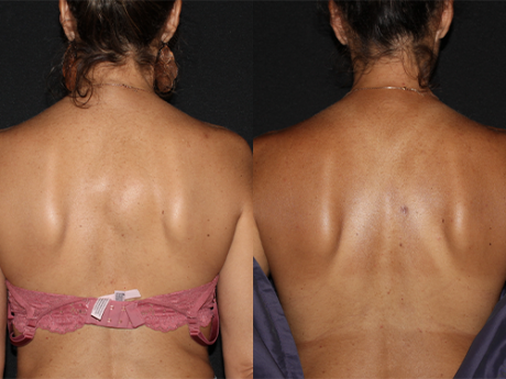 Minimal Scar Lipoma Removal case #43037